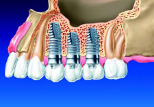 Одномоментная имплантация зубов