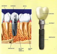 Конструкция зубного импланта